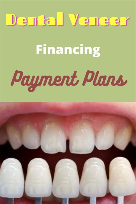 Since theyre usually not covered by insurance, you can expect an average of between 1,000 to 2,500 per tooth. . Veneers atlanta payment plan